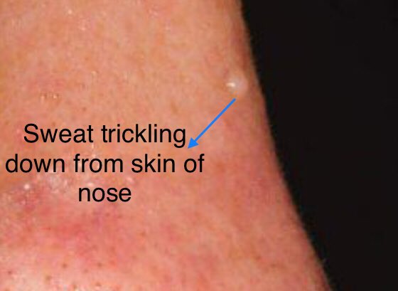TSM_Humanist's tweet image. ➡️Pic shows evidence of #Hyperhydrosis
-Very Sweaty Face
-Sweat is trickling down from the skin of nose &amp;amp; is about to fell down as a drop.
-Fluid is not coming out of Nares.
➡️ ? Idiopathic Hyperhydrosis 

Tests:
Iodine-starch test/sweat test.