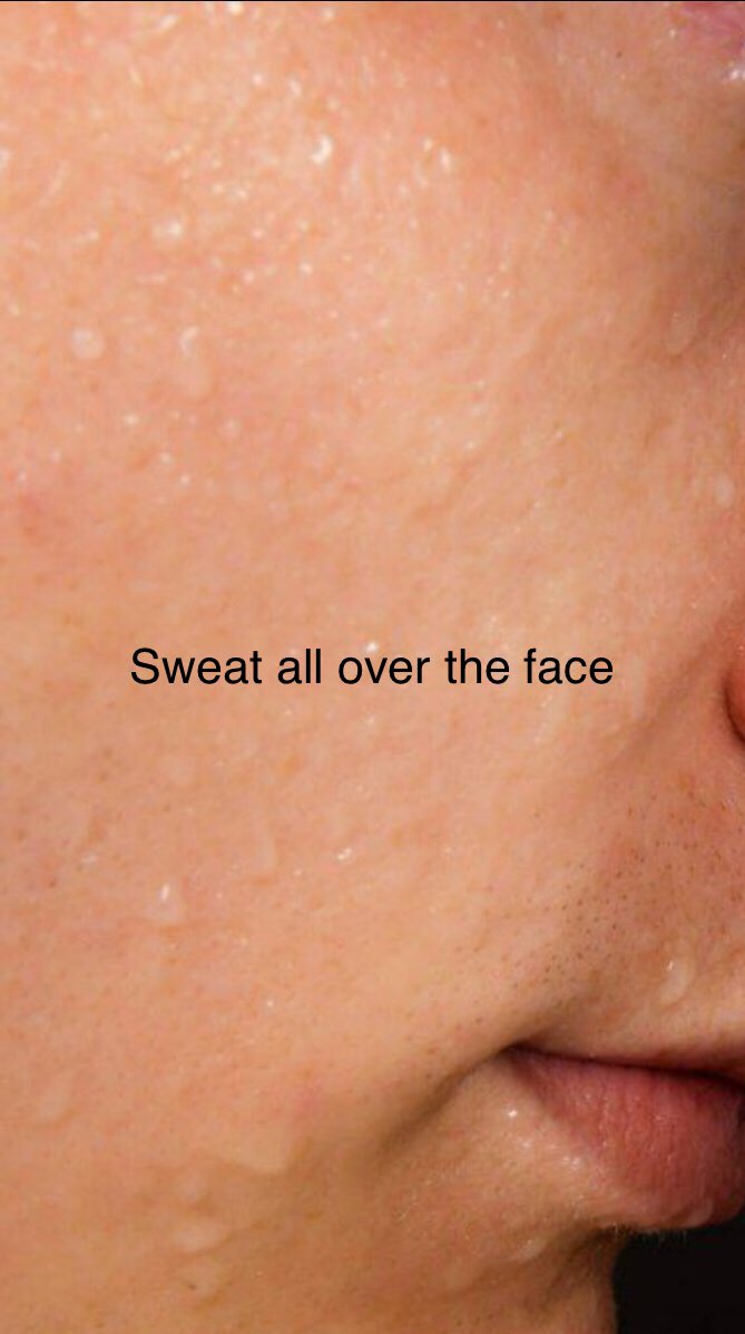 TSM_Humanist's tweet image. ➡️Pic shows evidence of #Hyperhydrosis
-Very Sweaty Face
-Sweat is trickling down from the skin of nose &amp;amp; is about to fell down as a drop.
-Fluid is not coming out of Nares.
➡️ ? Idiopathic Hyperhydrosis 

Tests:
Iodine-starch test/sweat test.