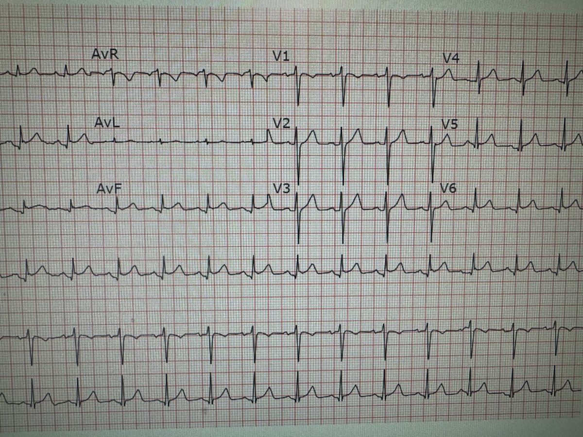 STEMI call was activated on this young smoker presenting with chest pain. What would you do next?