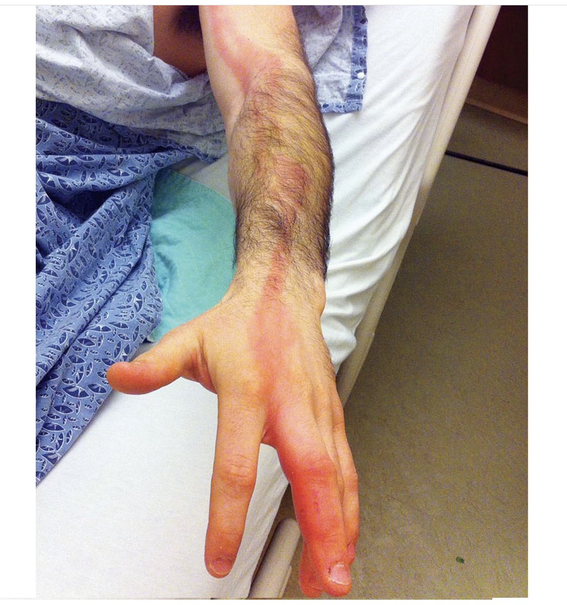 #Climical_Case🦠

A 23-year-old man presents with progressive left arm pain and erythema following an injury to his left third finger during a lacrosse game. 

What's the likely #diagnosis? 

#MedTwitter #Orthopedics #SportsMedicine'