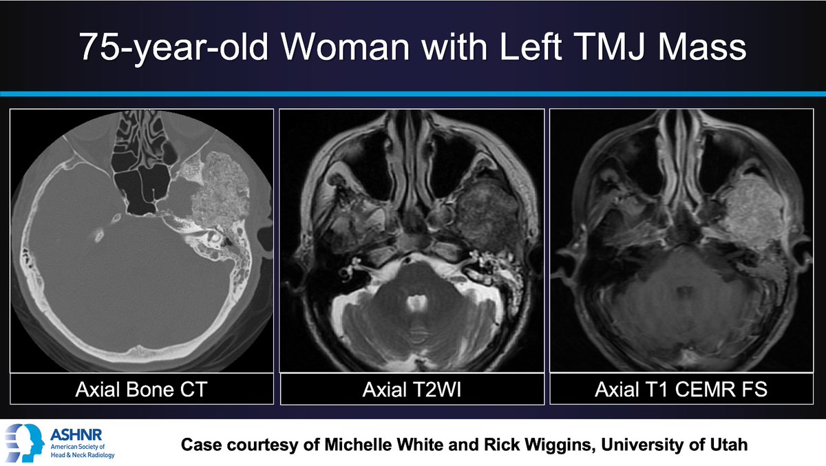 ASHNR (@ashnrsociety) on Twitter photo #ASHNRCOTW #244: L TMJ mass. Thx <a href="/Michelle_JW18/">Michelle White</a> + <a href="/rhwiggins/">Richard Wiggins</a> 4 case! #ASHNR24
Answer w/ appropriate GIF only -- stay professional & don't spoil it!
<a href="/callyrobs/">Caroline Robson, MBChB</a> <a href="/DShatzkes/">Deborah Shatzkes</a> <a href="/CDP_Rad/">C Douglas Phillips 🇺🇸</a> <a href="/nakoontz/">Nicholas Koontz</a> <a href="/KRileyMD/">Kalen Riley</a> <a href="/CMGlastonbury/">Christine M Glastonbury, MD</a> <a href="/cmtomblinson/">Courtney Tomblinson, MD</a> <a href="/tabby_kennedy/">Tabby A. Kennedy, MD</a> <a href="/PhilipRChapman1/">Philip R. Chapman, MD</a> @MohitAgNeurorad #ASHNRCOTW #244: L TMJ mass. Thx <a href="/Michelle_JW18/">Michelle White</a> + <a href="/rhwiggins/">Richard Wiggins</a> 4 case! #ASHNR24
Answer w/ appropriate GIF only -- stay professional & don't spoil it!
<a href="/callyrobs/">Caroline Robson, MBChB</a> <a href="/DShatzkes/">Deborah Shatzkes</a> <a href="/CDP_Rad/">C Douglas Phillips 🇺🇸</a> <a href="/nakoontz/">Nicholas Koontz</a> <a href="/KRileyMD/">Kalen Riley</a> <a href="/CMGlastonbury/">Christine M Glastonbury, MD</a> <a href="/cmtomblinson/">Courtney Tomblinson, MD</a> <a href="/tabby_kennedy/">Tabby A. Kennedy, MD</a> <a href="/PhilipRChapman1/">Philip R. Chapman, MD</a> @MohitAgNeurorad