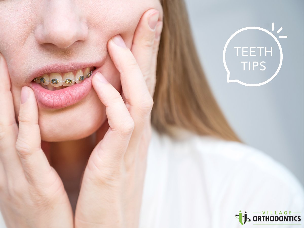 invisibleORTHO's tweet image. If one of your wires or brackets breaks, don't panic! Avoid causing more damage by not messing with it. Use wax or wet cotton to cover sharp edges, and give your orthodontist a ring ASAP. No need to stress; we've got you covered! #TeethTips 🚨