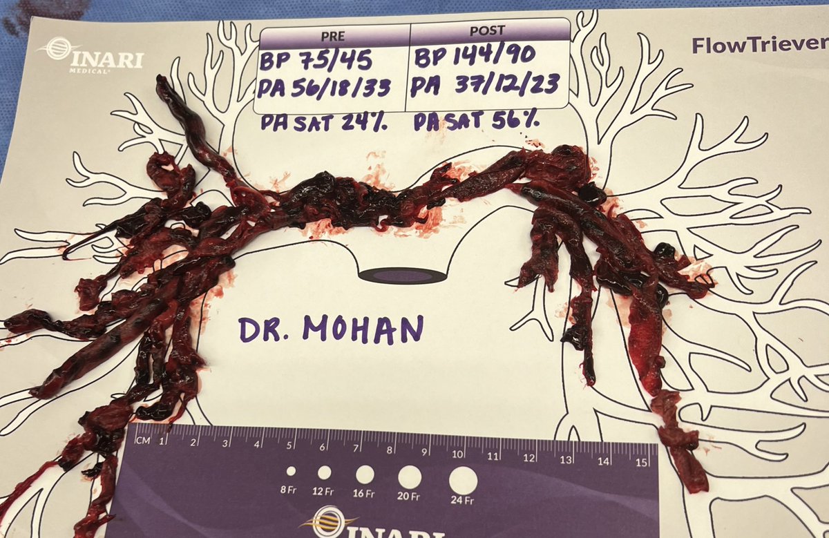 1/ Stable TO unstable HIGH RISK PE

Are we correctly stratifying PE patients and recognizing who needs immediate treatment? 

How are you assessing them and what time frame are you escalating therapy? 

What variables are you using? 

Lets discuss.. 

#VTE #PE #Cardiotwitter