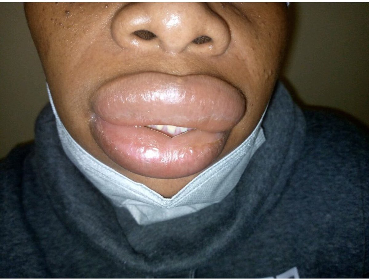 DrMedica_13's tweet photo. #PharmaMed๐
Angioedema can be caused by certain drugs. Which one?
A. Hydrochlorothiazide
B. Captopril
C. Atenolol
D. Amlodipine
#Medicine #DrugSideEffects" https://t.co/ImcI5SEHWg