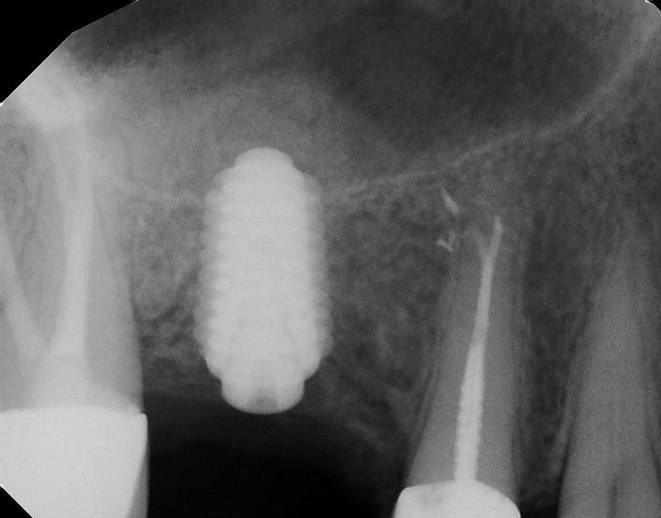 DrAlgufari's tweet photo. تقنيات #versah هي من اهم التقنيات و الاختراعات الحديثه في #زراعة_الاسنان Patented ( لا يمكن تصنيعها الا من قبل صاحب الاختراع ) و مرخصه من هيئات الدواء العالمية ومنها SFDA .
- تكثيف العظم وزيادة الحجم .
- عمليات رفع الجيوب الانفية الامنه دون اللجوء الى الجراحة الجانبيه . https://t.co/o2fM3mfmP1