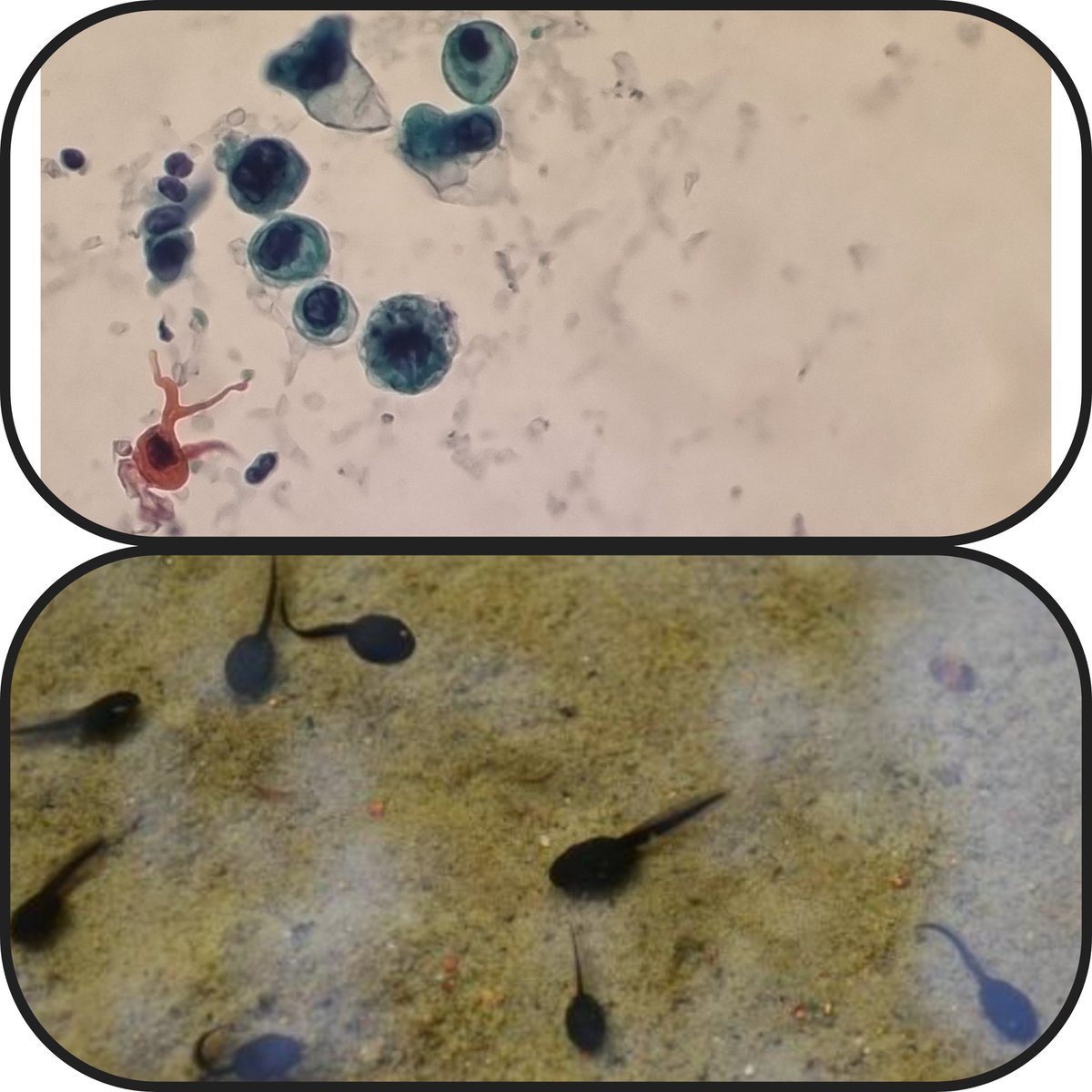 Juan José (@juanjocruzrueda) on Twitter photo 📆 6/3/24 🏥 <a href="/TorrecardenasHU/">Hospital Universitario Torrecárdenas</a>
🔬Imágenes curiosas para el neumólogo intervencionista🩻🫁
🔦💉EBUS-TBNA 11Rs
🌹ROSE. Dr. Velasco
🦀Carcinoma escamoso de pumón 📆 6/3/24 🏥 <a href="/TorrecardenasHU/">Hospital Universitario Torrecárdenas</a>
🔬Imágenes curiosas para el neumólogo intervencionista🩻🫁
🔦💉EBUS-TBNA 11Rs
🌹ROSE. Dr. Velasco
🦀Carcinoma escamoso de pumón