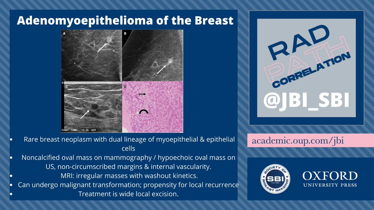 🔬 🔬 LATEST #JBI RAD-PATH CORRELATION 🔬 🔬 Adenomyoepithelioma of the breast from @MayoClinic 📩 📩 📩 Read more: bit.ly/3TptxoK