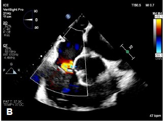 MyJSCAI's tweet photo. 📑💡Imaging is a critical component of the success of #TTVR. 🗣️Presented at #SIF2024 this article describes strategies &amp; techniques for the use of #3DICE as an adjunct to standard TEE during a TTVR procedure. #ICE

➡️https://t.co/xQ6ea7Pxmr 

 @caresans26 @StevenYakubov https://t.co/pfcsChUmBW