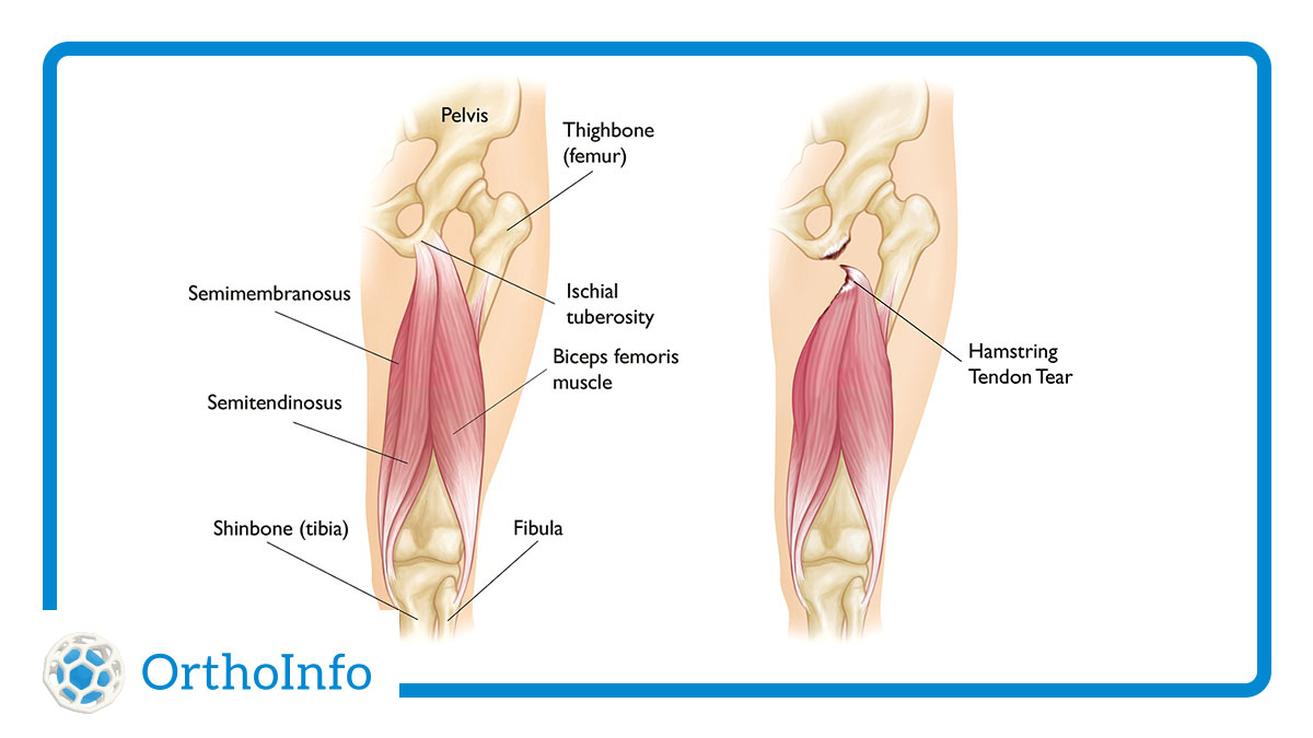 AAOS1's tweet image. Their #hamstringinjuries at the @NFL combine were disappointing, but Mizzou RB Cody Schrader &amp;amp; Georgia T Amarius Mims should be OK after rehab. Learn about treatment &amp;amp; recovery for a pulled hammy at #OrthoInfo: bit.ly/3P56yN2 @AOSSM_SportsMed @NCAAFootball #Orthotwitter