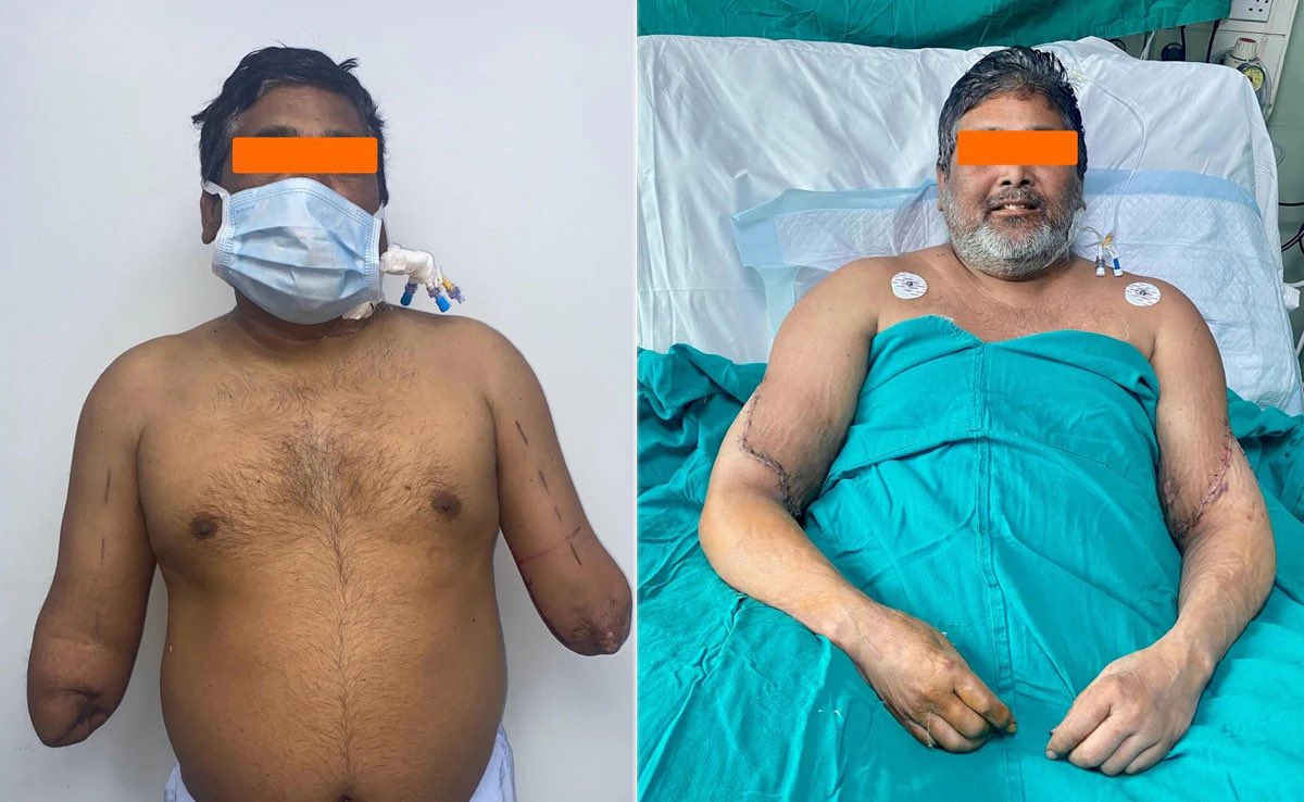 KoolZeroHero's tweet photo. #AskJesus why he never heals amputees?
#Science did, doctors did, nurses did.
Thanks to the remarkable surgical skill of a team of doctors in #Delhi and a woman's generous organ donation, a 45-year-old painter who lost both hands in a tragic accident is poised to wield his brush once more.
The successful bilateral hand transplant at Sir Ganga Ram Hospital marks a milestone for Delhi, offering hope to the underprivileged artist who faced a bleak future after his devastating injury in 2020.
The hands of Meena Mehta, a former school administrator who pledged her organs before her passing, have now breathed new life into four individuals, including the grateful painter.
The intricate surgery, spanning over 12 hours, meticulously reconnected arteries, muscles, tendons, and nerves, achieving the unimaginable.
#India #amputee #hero
https://t.co/n0CT2DzffN