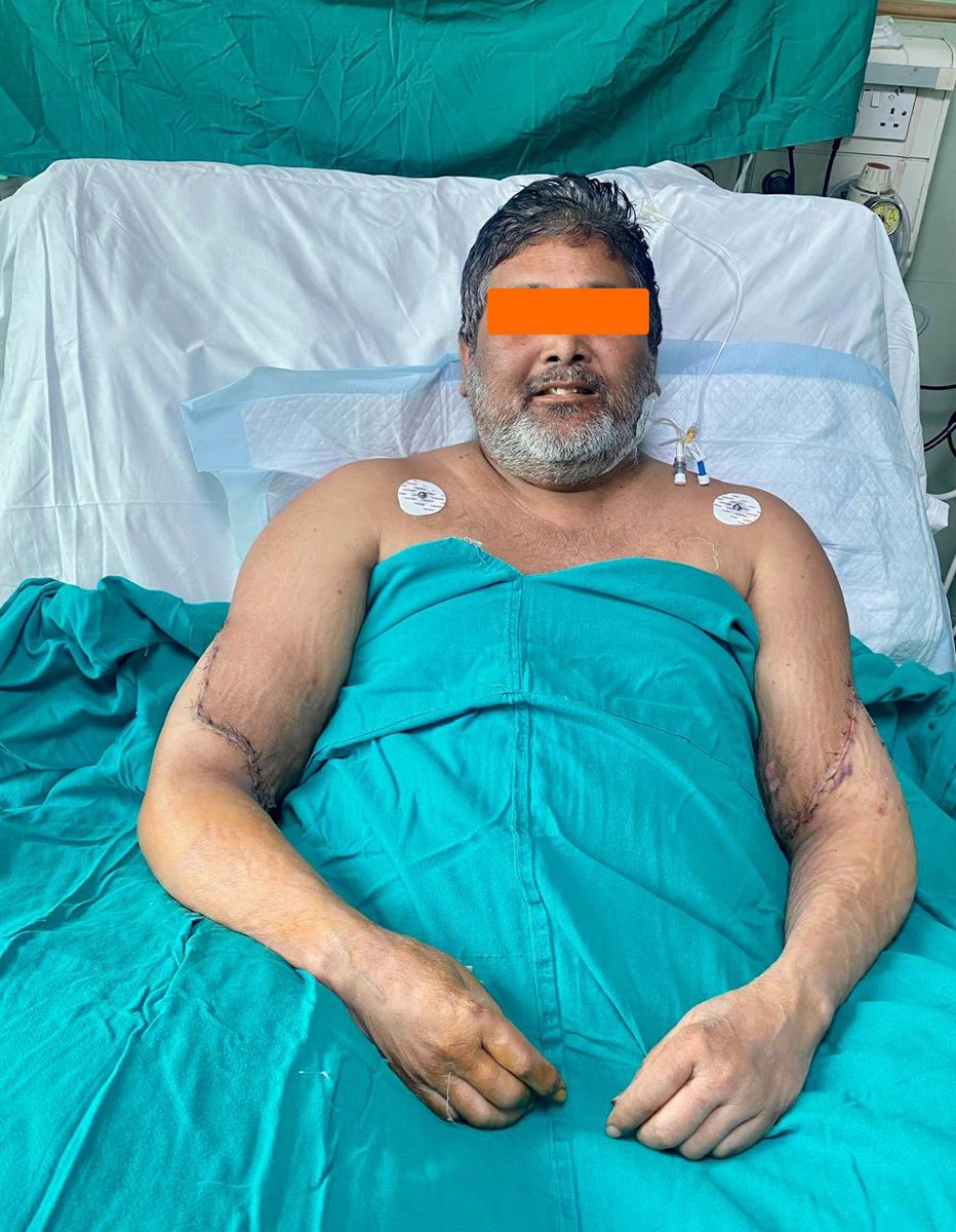 KoolZeroHero's tweet photo. #AskJesus why he never heals amputees?
#Science did, doctors did, nurses did.
Thanks to the remarkable surgical skill of a team of doctors in #Delhi and a woman's generous organ donation, a 45-year-old painter who lost both hands in a tragic accident is poised to wield his brush once more.
The successful bilateral hand transplant at Sir Ganga Ram Hospital marks a milestone for Delhi, offering hope to the underprivileged artist who faced a bleak future after his devastating injury in 2020.
The hands of Meena Mehta, a former school administrator who pledged her organs before her passing, have now breathed new life into four individuals, including the grateful painter.
The intricate surgery, spanning over 12 hours, meticulously reconnected arteries, muscles, tendons, and nerves, achieving the unimaginable.
#India #amputee #hero
https://t.co/n0CT2DzffN