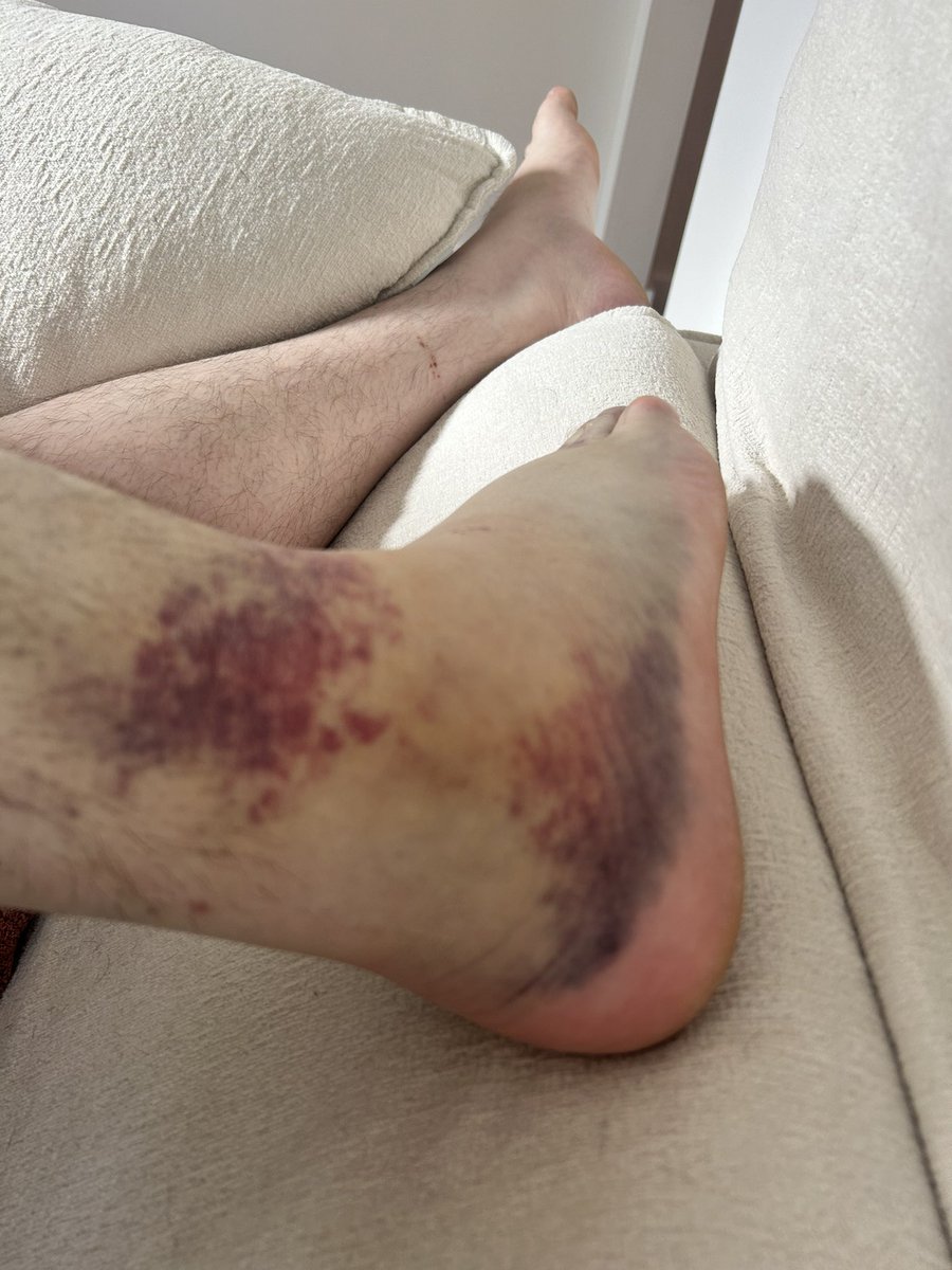 Chads ankle after the most recent celebrity alcohol video, go watch that shit!