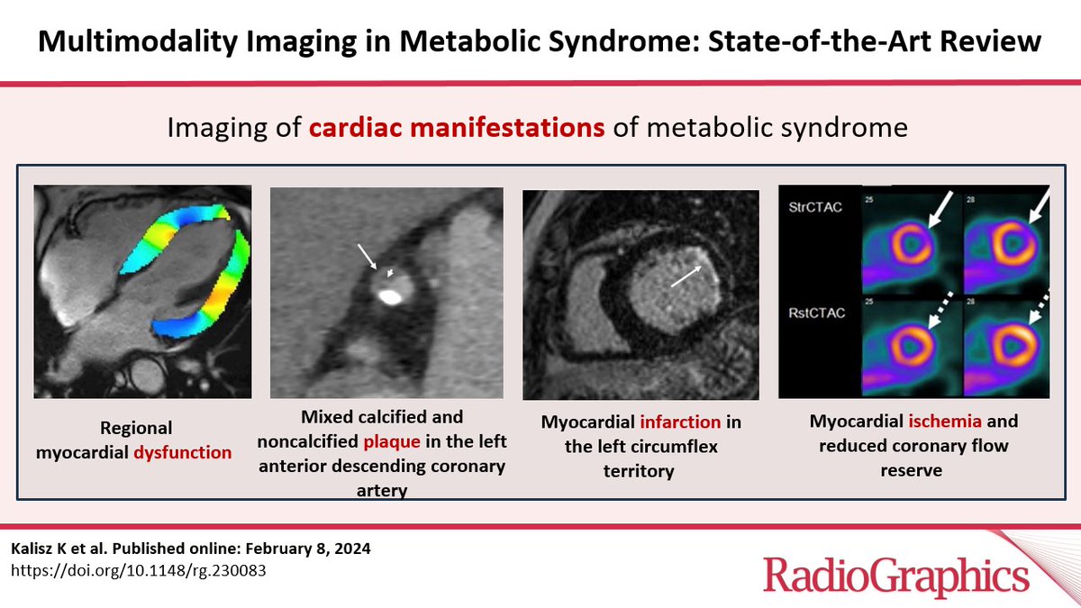 Multimodality Imaging in Metabolic Syndrome: State-of-the-Art Review ​ Kalisz K et al. Multisystem Radiology doi.org/10.1148/rg.230… @PR_CVRad @MRElastography @ItaniMalak @AmitAgarwalMD #RGphx 7/12