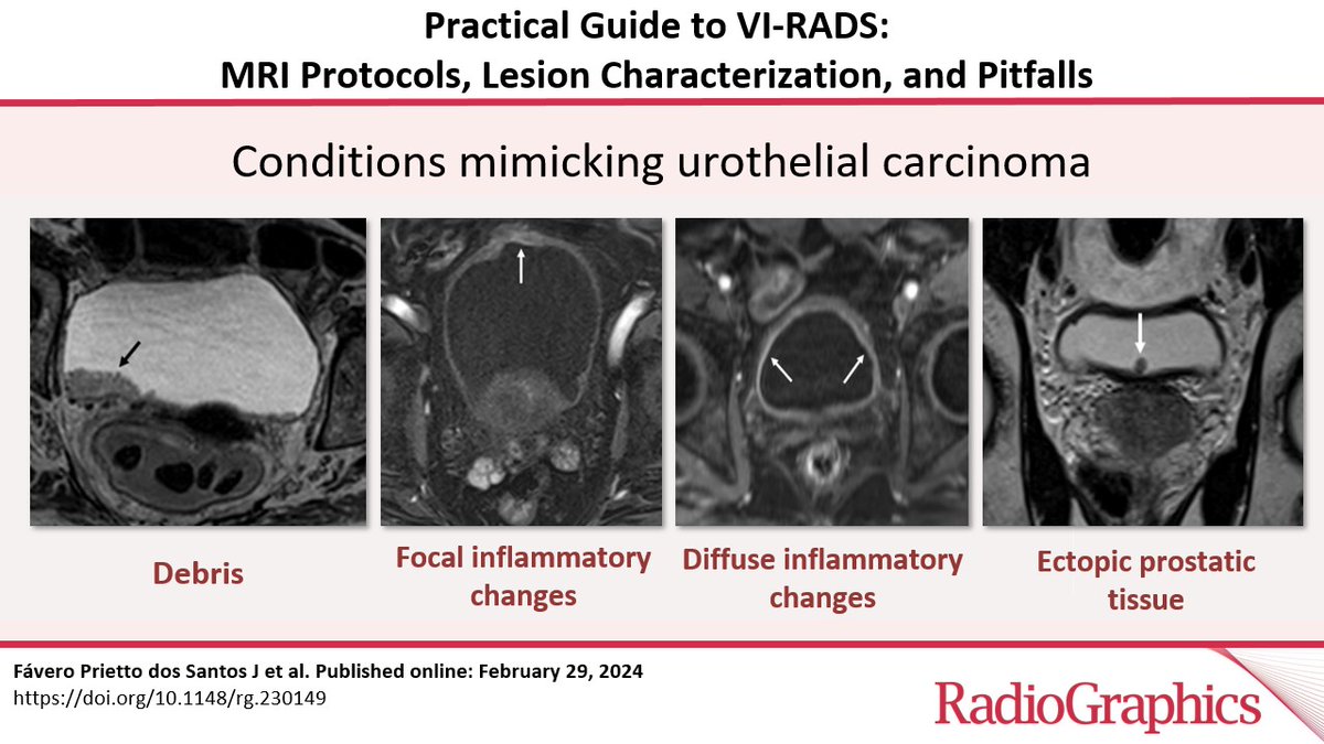 RadioGraphics_Editor (@radg_editor) on Twitter photo Practical Guide to VI-RADS: MRI Protocols, Lesion Characterization, and Pitfalls
Fávero Prietto dos Santos J et al.
GU Imaging
doi.org/10.1148/rg.230…
<a href="/JonatasFavero/">Jônatas Fávero</a>
<a href="/IvanPedrollo/">Ivan Pedrollo</a>
<a href="/italorcruz/">Ítalo Cruz</a>
<a href="/mauzappa/">Mauricio Zapparoli, MD MSc</a>
<a href="/SchuchAlice/">Alice Schuch</a>
<a href="/MugliaValdair/">Valdair Muglia_MD</a>
#RGphx
5/12 Practical Guide to VI-RADS: MRI Protocols, Lesion Characterization, and Pitfalls
Fávero Prietto dos Santos J et al.
GU Imaging
doi.org/10.1148/rg.230…
<a href="/JonatasFavero/">Jônatas Fávero</a>
<a href="/IvanPedrollo/">Ivan Pedrollo</a>
<a href="/italorcruz/">Ítalo Cruz</a>
<a href="/mauzappa/">Mauricio Zapparoli, MD MSc</a>
<a href="/SchuchAlice/">Alice Schuch</a>
<a href="/MugliaValdair/">Valdair Muglia_MD</a>
#RGphx
5/12