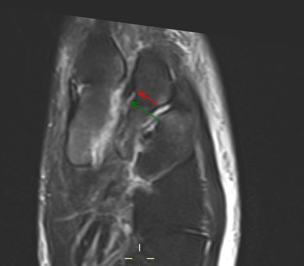 Lisfranc Injury - Weightbearing AP XR: asymmetric widening of intermetatarsal space - CT: Fracture of lateral aspect of C1 caused by avulsion of Lisfranc ligament (C1-M1) - MR: Lisfranc ligament appears preserved and cortical C1 avulsion is inferred.