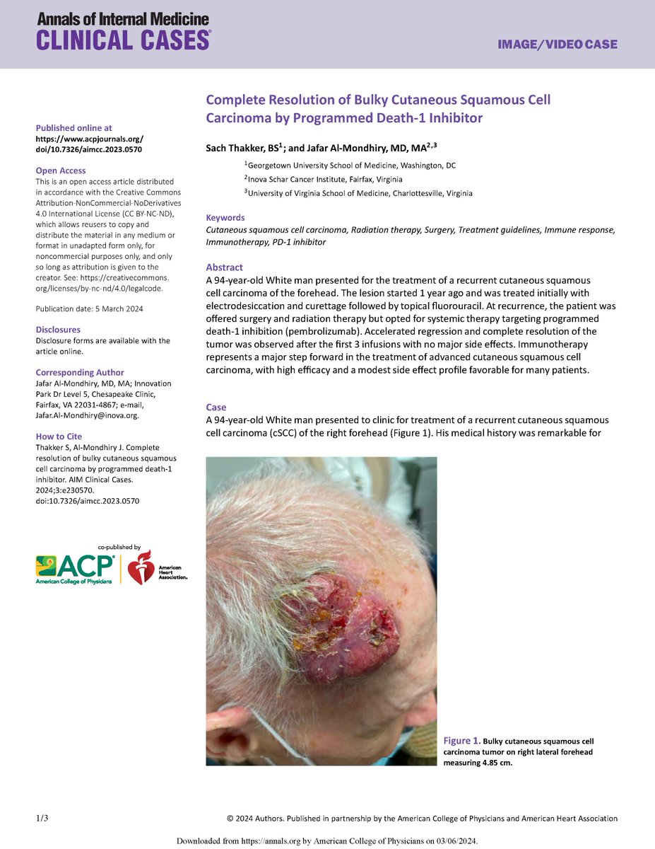 Annals of Internal Medicine: Clinical Cases (@annalsofimcc) on Twitter photo Complete Resolution of Bulky Cutaneous Squamous Cell Carcinoma by Programmed Death-1 Inhibitor. Full text of this image case report from <a href="/sachthakker/">Sach Thakker</a> <a href="/GUMedicine/">Georgetown Medicine</a> <a href="/InovaSchar/">Inova Schar Cancer Institute</a> <a href="/MedicineUVA/">UVA School of Medicine</a> is freely available at ow.ly/QTAa50QN6Oc Complete Resolution of Bulky Cutaneous Squamous Cell Carcinoma by Programmed Death-1 Inhibitor. Full text of this image case report from <a href="/sachthakker/">Sach Thakker</a> <a href="/GUMedicine/">Georgetown Medicine</a> <a href="/InovaSchar/">Inova Schar Cancer Institute</a> <a href="/MedicineUVA/">UVA School of Medicine</a> is freely available at ow.ly/QTAa50QN6Oc