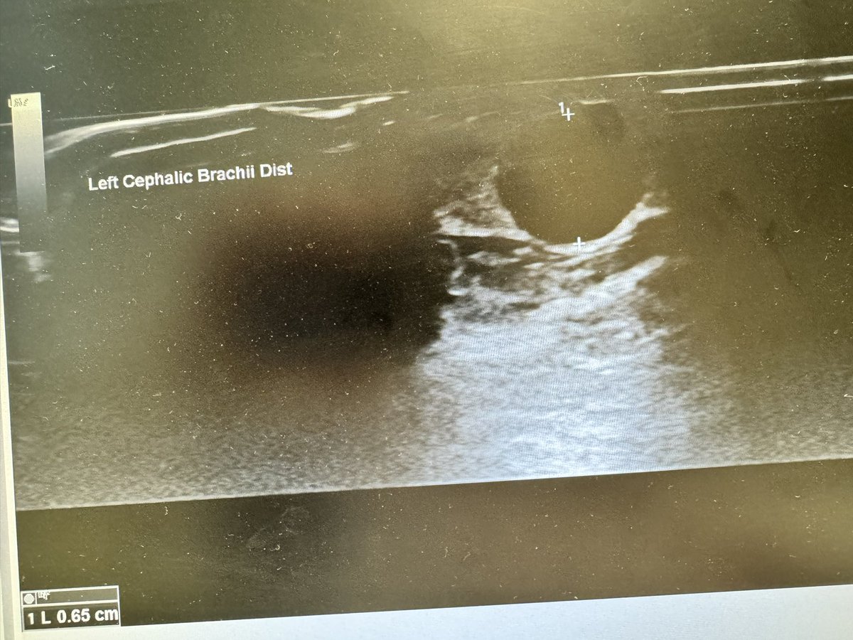 How can anyone predict maturation of an #AVF? If you do, please let me know how. Here is an example of a 4 weeks old Gracz AVF created with 2.3x3.1 mm AV anastomosis. Better than simply matured. #vascularaccesscenter #hamburg
