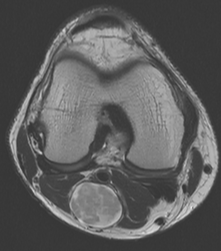 Peripheral nerve sheath tumor High signal fusiform mass with tapered ends, with posterior tibialis nerve leading into and out of the mass