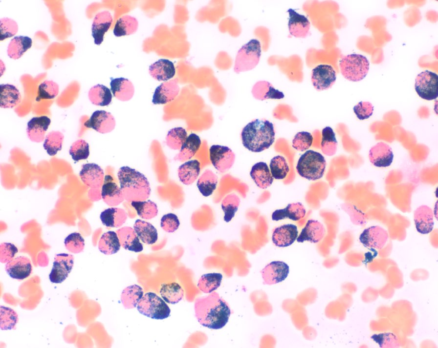 The one #hemepath Dx you should NEVER miss You get it ✅: patient gets cured 👍🏻. You get it ❌: patient dies 🪦 (I’m being dramatic.. but you get the point) ACUTE PROMYELOCYTIC LEUKEMIA PML::RARA The MPO stain is your friend: blasts are strong uniform + (quick & inexpensive)…