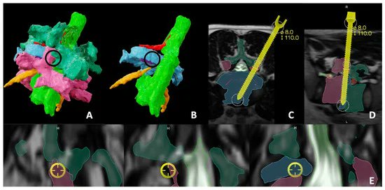 abdelbarrspine's tweet photo. New:Using Augmented Reality Technology to Optimize Transfacet Lumbar Interbody Fusion: A Case Report
https://t.co/dSb8ob9gJd

Describe the use of advanced preoperative planning, intraoperative augmented reality to see ‘through’ the bone while doing a TLIF.  

@DukeSpine https://t.co/gduZovTvLz