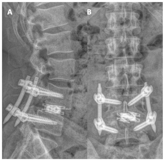 New:Using Augmented Reality Technology to Optimize Transfacet Lumbar Interbody Fusion: A Case Report mdpi.com/2077-0383/13/5… Describe the use of advanced preoperative planning, intraoperative augmented reality to see ‘through’ the bone while doing a TLIF. @DukeSpine