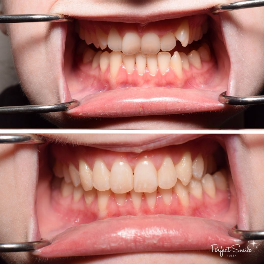 theperfectsmile's tweet photo. Just a few short months and this patient now has a straighter, more functional smile. We started by giving her this great foundation for health (Invisalign) now she’s ready for whitening/brightening!

✨Get $1,100 off our lowest price on... https://t.co/CJcJqlWMMI
*Regular https://t.co/JcJS0K0C3g