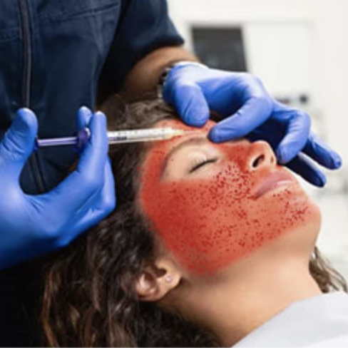 #idboardreview cisgender female tests positive for HIV (previously neg). Monogamous with 1 male partner (who tests negative), no history of STIs/injection drug use/transfusion. Patient had received 'vampire facial' at a non-licensed spa few months ago. Route? #idxposts #idtwitter