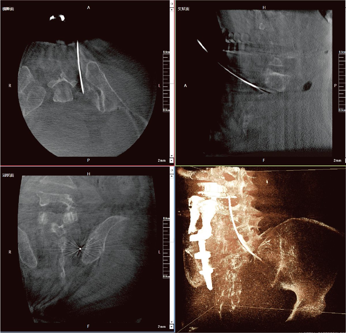 perlove_robot's tweet photo. [Clinical Case ]

a robot-assisted bone biopsy performed on a 61-year-old female patient diagnosed with bone tumors and severe bone destruction.we're dedicated to delivering superior patient care and outcomes.

#BoneBiopsy #RoboticSurgery #MedicalInnovation https://t.co/3dbhUygjfr