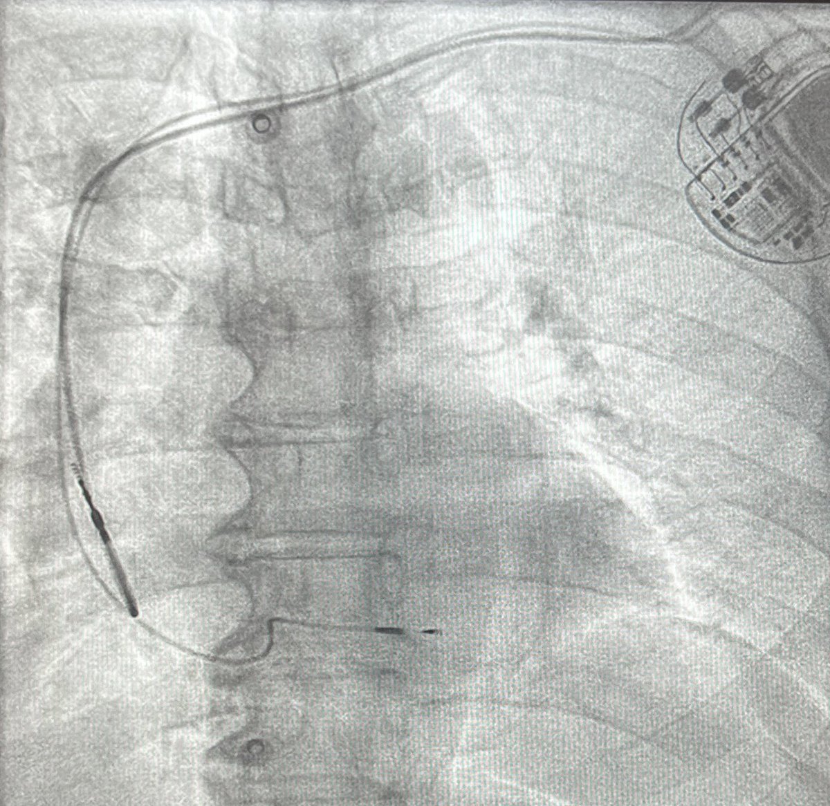 EPWaveDoc's tweet photo. Dual chamber #pacemaker w #LPFP @CHUM972 for 71 yo patient w complete heart block from another island. What’s your favorite #CSP site #Epeeps ? Please comment. ➡️Poll https://t.co/Ldc3lPY4wa