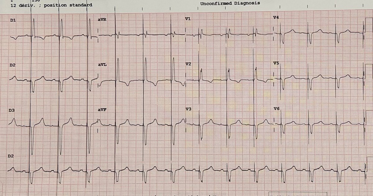 EPWaveDoc's tweet photo. Dual chamber #pacemaker w #LPFP @CHUM972 for 71 yo patient w complete heart block from another island. What’s your favorite #CSP site #Epeeps ? Please comment. ➡️Poll https://t.co/Ldc3lPY4wa