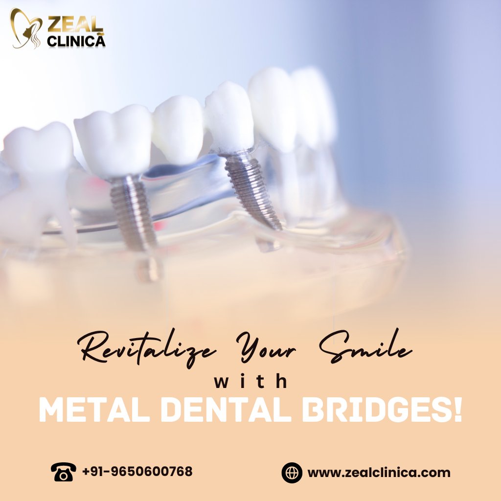 Transform your smile 😁 with strength and style! 💪🦷 Introducing Metal #DentalBridges – the durable solution for missing teeth that seamlessly blends in with your natural #Smile. . . #dental #dentalcare #dentalhealth #dentalhygiene #dentalbridge #metalbridges #teethgaps