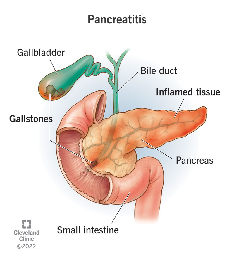 💊Drug-induced Pancreatitis

The 7 drug classes / drugs most associated with causing pancreatitis include:

◾️ statins

◾️ ACE inhibitors

◾️ oral contraceptives / HRT

◾️ diuretics

◾️ antiretroviral drugs

◾️ valproic acid

◾️ oral hypoglycemic agents