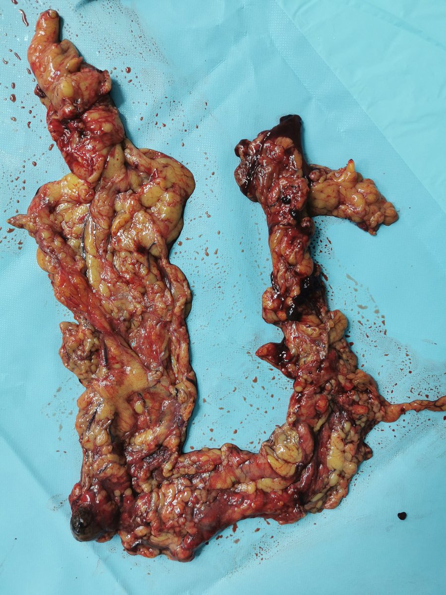 En-bloc posterior-pelvic exenteration, diaphragmatic stripping, and omentectomy. Hoping the patient benefits from an R0 resection.#gynecologic #oncology #OvarianCancer