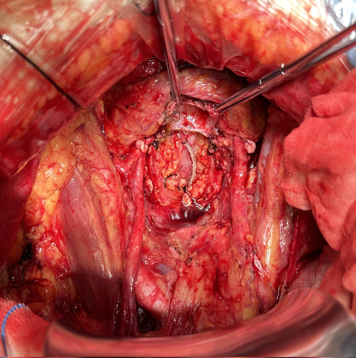 RichardJing4's tweet photo. En-bloc posterior-pelvic exenteration, diaphragmatic stripping, and omentectomy. Hoping the patient benefits from an R0 resection.#gynecologic #oncology #OvarianCancer https://t.co/DOl85Syieb