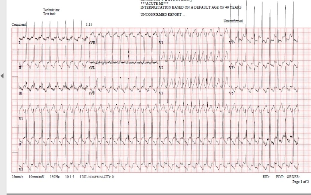 44 M
Known dilated cardiomyopathy on HF meds (sacubitril/valsartan and carvedilol)
Palpitations for 3 hours.
Whats the initial rythm.? (PR > 200) 
2nd ecg, post adenosine (6,12, then converted/slowed on 18) 
Whats the 2nd rythm.?