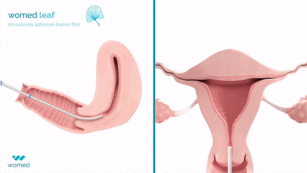 IBMM_Balard's tweet photo. 🎺 Breaking news ! #Womed dévoile le premier dispositif pour restaurer la fertilité, dont l'efficacité est prouvée par une étude clinique randomisée !!
Pour en avoir plus : https://t.co/XHIvh39Qub https://t.co/6synjYONsV