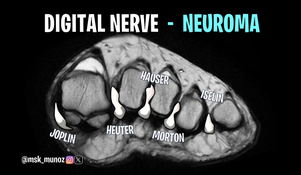 INTERMETATARSAL NEUROMA 3rd > 2nd intermetatarsal spaces most affected Neural edema, demyelination and perineural fibrosis Neuroma in adjacent space: 28% More symptomatic > 5mm Intermetatarsal bursae ≤ 3 mm is considered physiologic #foot