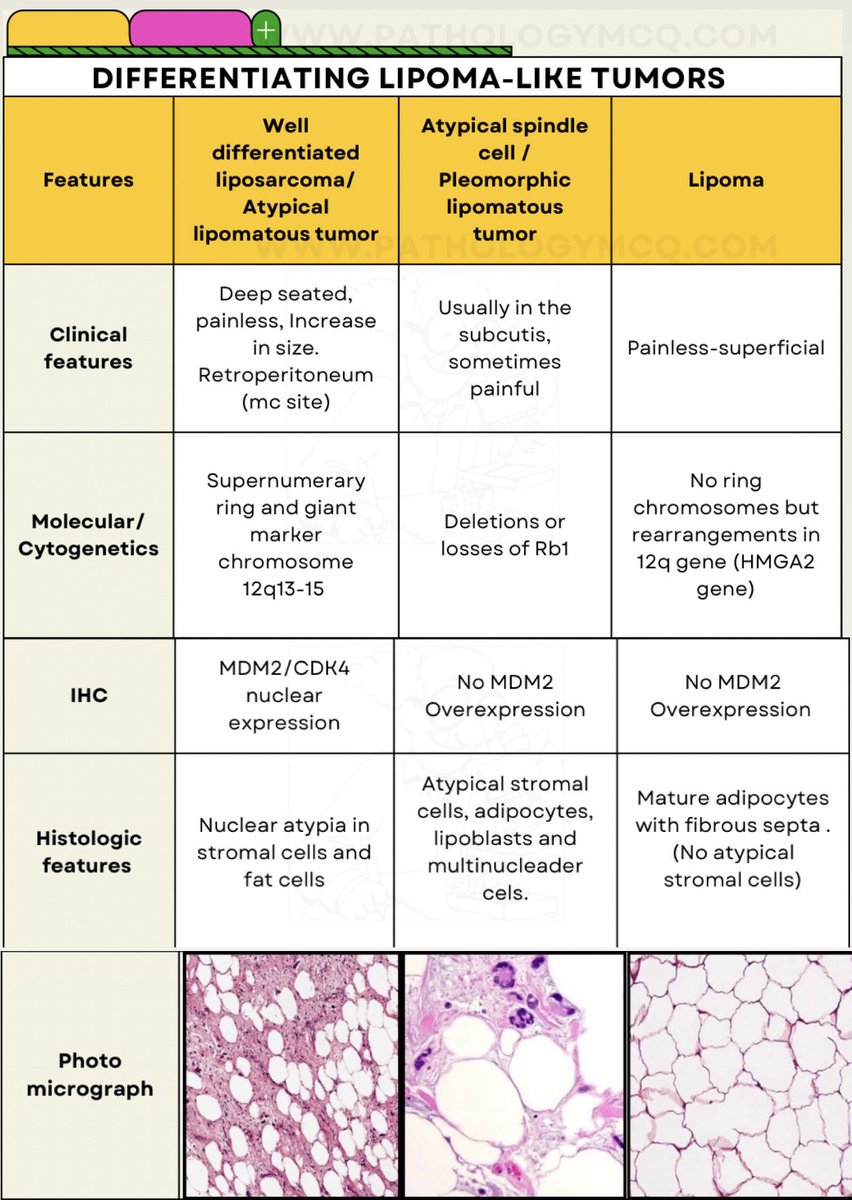 Differentiation table summarizing the differences between - lipoma , atypical spindle cell lipomatous tumor and well differentiated liposarcoma.