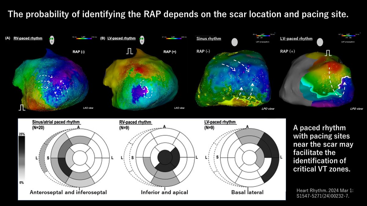 Very intriguing data from Tsukuba!! 🎊
Discovering the optimal cardiac rhythm (sinus/RV-paced/LV-paced) during substrate mapping in scar-related VT helps all VT ablators predict an appropriate VT ablation target.🎯
#EPeeps #VT #HeartRhythm
heartrhythmjournal.com/article/S1547-…
