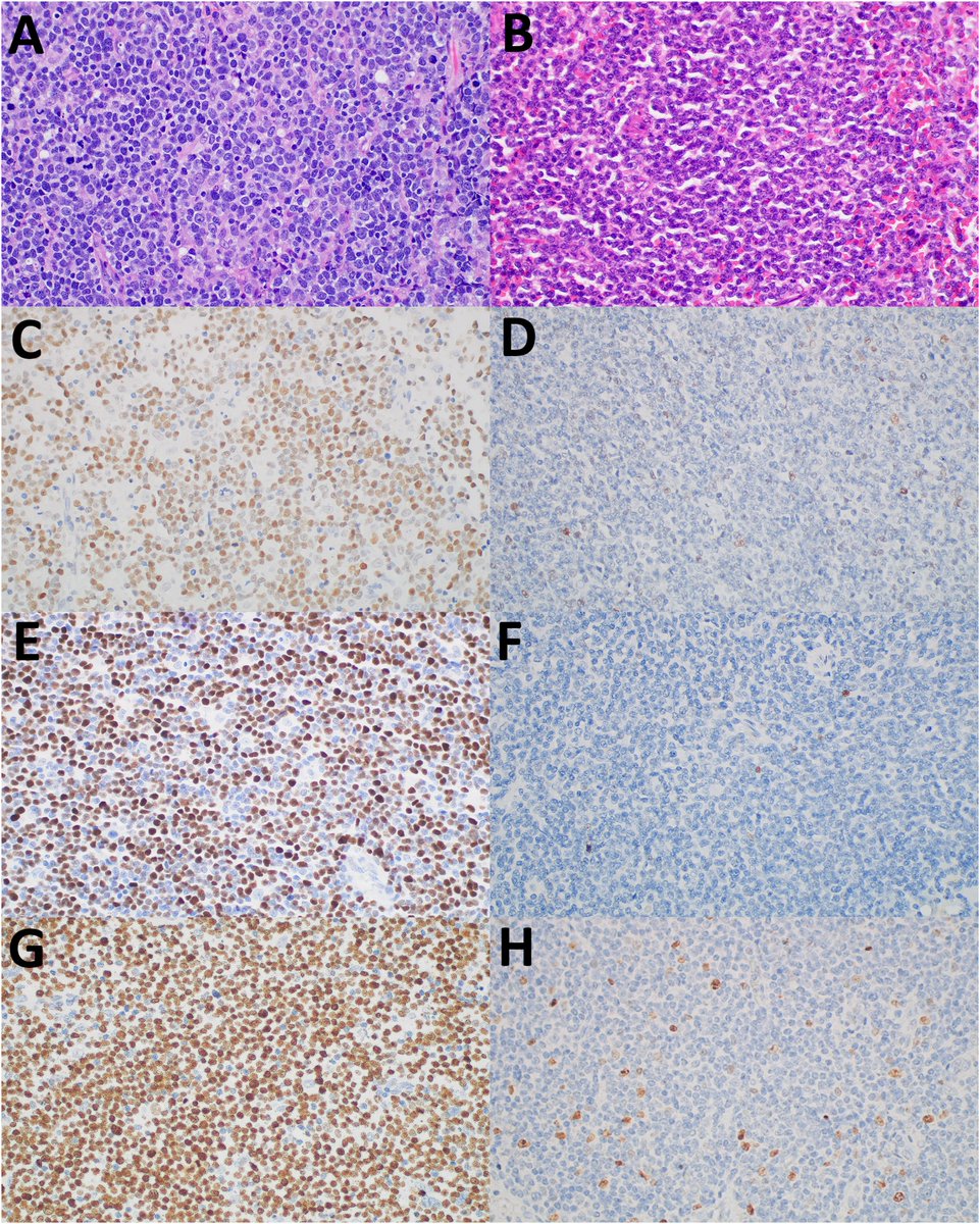 New in #HumPathol: TP53 mutation is frequent in mantle cell lymphoma with EZH2 expression and have dismal outcome when both are present. sciencedirect.com/science/articl… #pathology #PathTwitter #hemepath