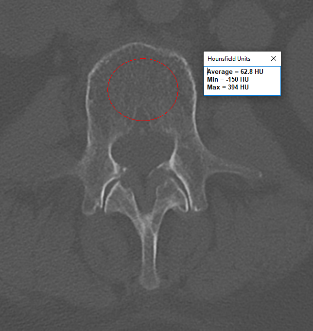 How would you manage osteoporosis, and surgical plan? 70F, progressive back pain when upright and forward leaning posture, multiple compression fractures with kyphotic deformity, failed nonop. Lowest t-score -2.3 at femoral neck, L1 HUs 62, FRAX 18% MOF and 7.3% hip fx.