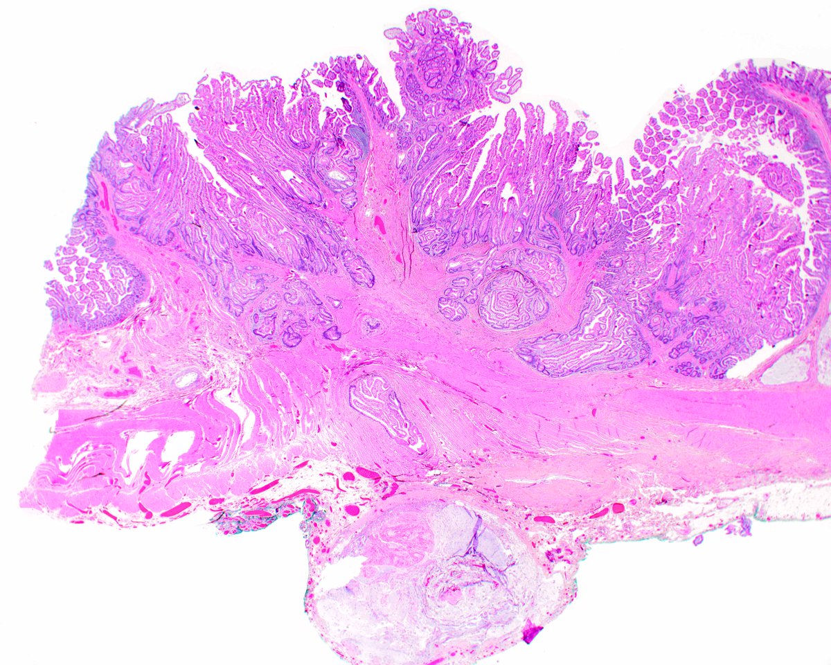 LizMontgomeryMD's tweet photo. As a result of intussusception, this benign Peutz-Jeghers polyp has undergone enteritis cystica profunda. The deep glands are accompanied by their investing lamina propria. Entrapped mucin creates a  tissue response mimicking carcinoma.  #UMiamiPath https://t.co/f3ZBWEUKvk