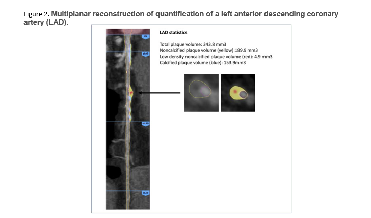 Journal of Cardiovascular CT tweet media