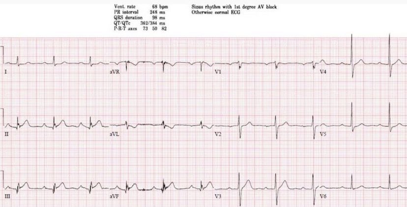 65 year old with chest pain. What do you think? Is this ECG “normal”? #ECG #EKG #FOAMed #MedEd #CardioTwitter #EmergencyMedicine #medicalstudent @ECGcases @EMCases
