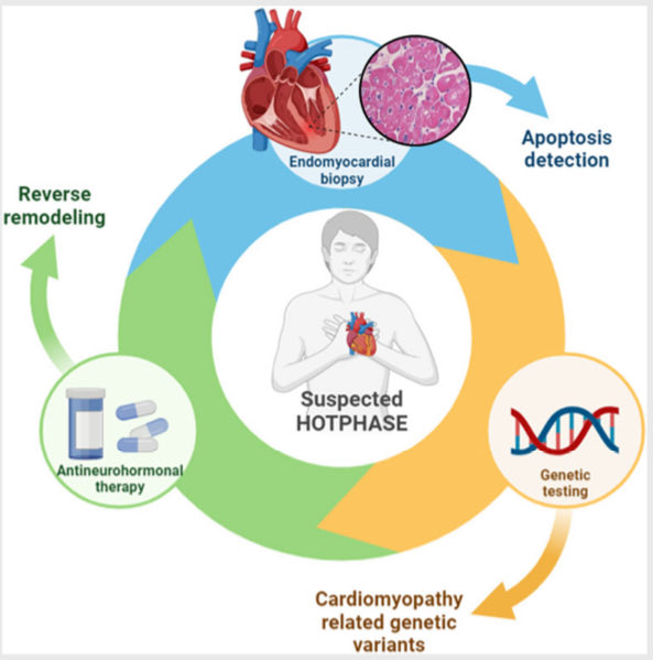 🔴 Apoptosis, a useful marker in the management of hot-phase cardiomyopathy? @ESC_Journals #Cardioed #Cardiology #CardioTwitter