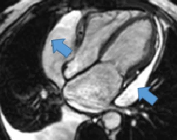 ZHeart11768530's tweet photo. 🔴 Role of Cardiac MRI in Pericardial Diseases #2024Review
https://t.co/Qro9Z0ISEb
#cardiology #cardiotwitter #CardioEd #medical #meded #whymri #cardiology #CardioEd #cardiox https://t.co/u8OTJOYDv0