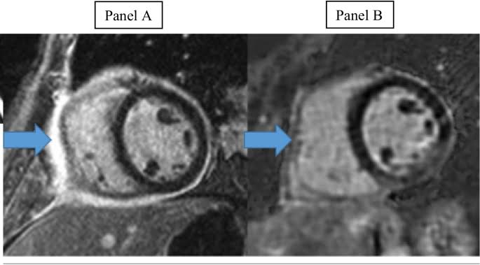ZHeart11768530's tweet photo. 🔴 Role of Cardiac MRI in Pericardial Diseases #2024Review
https://t.co/Qro9Z0ISEb
#cardiology #cardiotwitter #CardioEd #medical #meded #whymri #cardiology #CardioEd #cardiox https://t.co/u8OTJOYDv0
