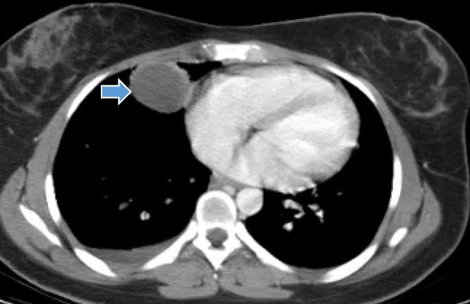 ZHeart11768530's tweet photo. 🔴 Role of Cardiac MRI in Pericardial Diseases #2024Review
https://t.co/Qro9Z0ISEb
#cardiology #cardiotwitter #CardioEd #medical #meded #whymri #cardiology #CardioEd #cardiox https://t.co/u8OTJOYDv0