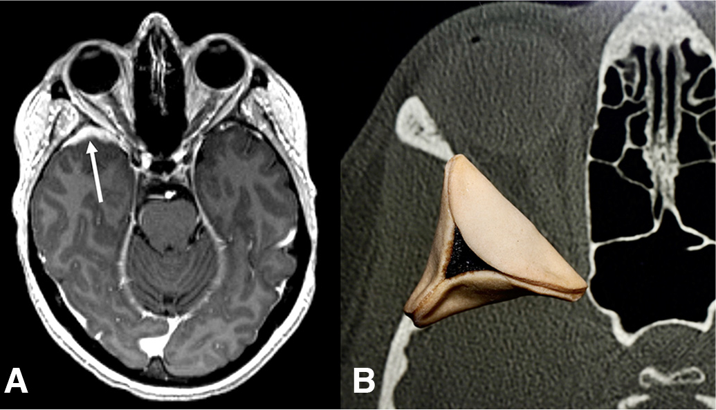 From the October-December 2023 Issue of #Neurographics: The “Hamantaschen” Sign: A Unique Appearance of Lesions Arising from the Sphenoid Greater Wing ow.ly/OXxS50QtHtr