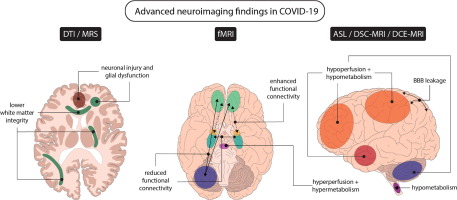 Noa van der Knaap @NoaKnaap provides an excellent overview of neuroimaging evidence of abnormalities in COVID-19 in @eic_nic, with @aries_marcel & @iccvanderhorst doi.org/10.1016/j.nicl…